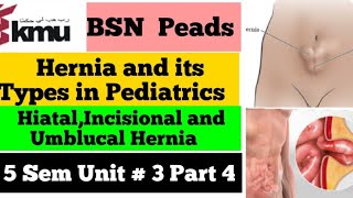 What You Need to Know About Umbilical Hernia Causes and Symptoms [upl. by Anicul893]