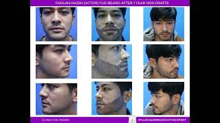 FUE Beard Result after 1 Year if 1200 Grafts  Fadlan Hazim an Malaysia Actor  Clinic Dr Inder [upl. by Enilec]