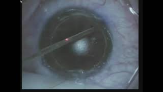 LASIK flap lift enhancement using CzarnotaNowakowska Technique [upl. by Haimorej]