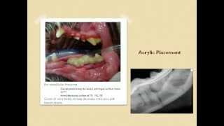 NonInvasive Mandibular Fracture Repair [upl. by Edahc]