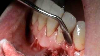 Atlanta Periodontist Georgia GA Cyst Removal Bone Grafting Surgery [upl. by Perla]