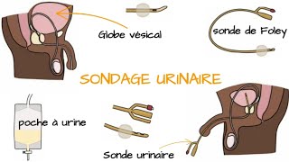 Comprendre le SONDAGE URINAIRE [upl. by Naed630]