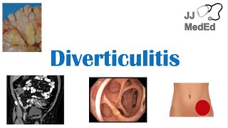 Diverticulitis Risk Factors ex Low Fiber Diets Symptoms Diagnosis Treatment and Complications [upl. by Cece]