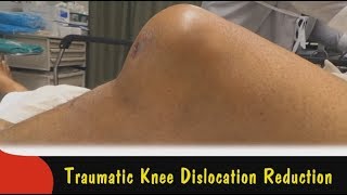 Traumatic Knee Dislocation Reduction [upl. by Akinak924]