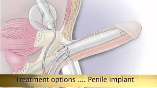 Potency ED Treatment Options [upl. by Rabi]