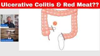 Ulcerative Colitis amp Red Meat Warning KENTCARNIVORE [upl. by Wickham]