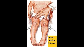 Leg deformities In toeing and Out toeing [upl. by Champ]