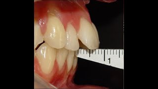 Non Surgical Orthodontic treatment of Skeletal Class II with 7mm Overjet [upl. by Htebazil]