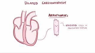 Dilated cardiomyopathy DCM causes symptoms diagnosis treatment amp pathology [upl. by Naro]