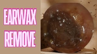 P12 The Wax Whisper  Extract Hardened Ear Wax With The WAX scope [upl. by Genisia]