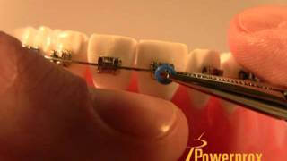 How to Tie an ORing Elastic Powerprox Six Month Braces Orthodontic Education Video [upl. by Rhoda289]