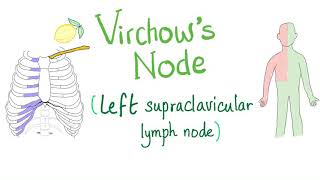 Virchows Node Left Supraclavicular Lymph Node  Cancer  Oncology [upl. by Hoisch]