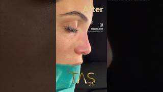 Rhinoplasty By Dr TAS beforeandafter drsuleymantas tasmedicalcenter [upl. by Fredric]