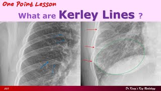 Kerley Lines on Chest PA Radiographs [upl. by Oirromed]