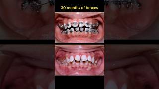 Braces very gap and buck teeth braces orthodontist niengrang dentist [upl. by Hillel]