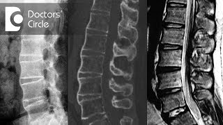 What do sclerotic lesion on spine mean  Dr Kodlady Surendra Shetty [upl. by Asylla618]