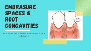 What are embrasure spaces and root concavities Lets look at interdental aids [upl. by Sisely825]