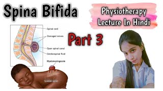 Spina Bifida  Occulta Meningocele Myelomeningocele spinabifidaphysiotherapymedicalstudent [upl. by Aileek885]