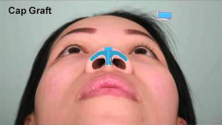 Asian Rhinoplasty Tip Augmentation Case Study Part 2  Dr Thomas Buonassisi 8 West Clinic in BC [upl. by Wagoner]