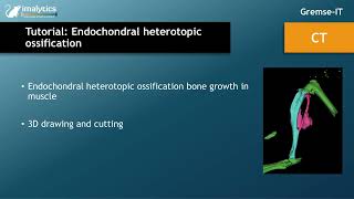 Tutorial video CT quotEndochondral heterotopic ossificationquot [upl. by Chip276]