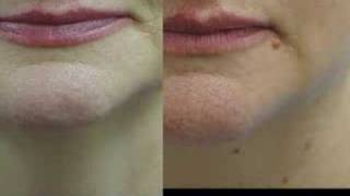 Erbium Laser Resurfacing Before and After Phots [upl. by Orit]