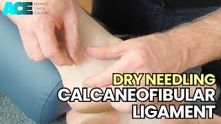 Dry Needling Calcaneofibular Ligament CFL [upl. by Etnomed732]