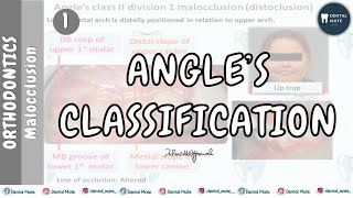 Angles Classification of Malocclusion  Dr Paridhi Agrawal [upl. by Lime486]