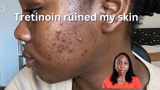 How Tretinoin ruined my skinDont make these mistakes [upl. by Isej260]