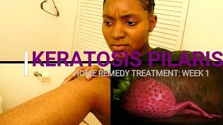 HOW TO REMOVE KERATOSIS PILARIS Week 1 Home Remedy Treatment [upl. by Garratt118]