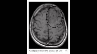 Oligodendroglioma [upl. by Ninazan39]