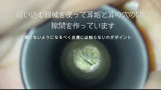 耳鼻科での耳掃除はどうやるの？？How does an otolaryngologist clean earwax [upl. by Baggs]