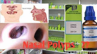 Nasal PolypsHomeopathic Medicine for Nasal Polyps Nasal polyps [upl. by Ali959]