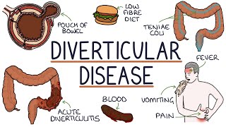 Understanding Diverticulosis and Diverticulitis [upl. by Suanne]