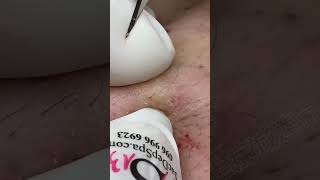 Blackhead Removal Acne Removal Treatment 08 [upl. by Adnilahs559]