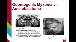 Odontogenic myxoma [upl. by Daisey775]