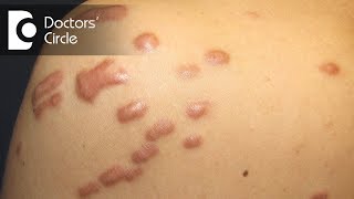 What is the best treatment for Keloid in young people  Dr Pavan Murdeshwar [upl. by Oalsinatse]