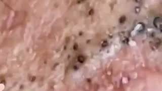 Relax With BlackHead Removal  Get Ready for an Intense Pimple Popping Adventure Video [upl. by Adnilak600]