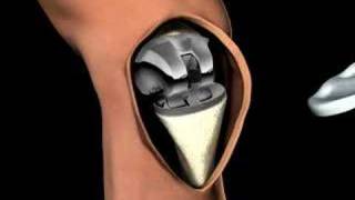 3D Medical Animation of a Knee Replacement [upl. by Leesa895]