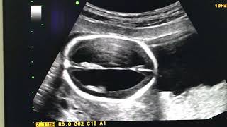 Hydrocephalus USG Ultrasound [upl. by Veejar]