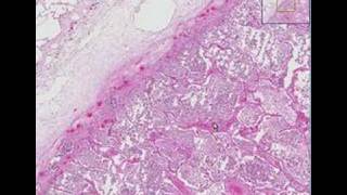 Histopathology Lung Lobar pneumonia [upl. by Idieh]