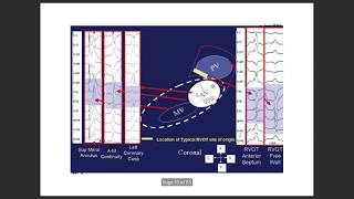 Ventricular tach localisation by ecg VTlocalisation ventriculartachycardia VPC [upl. by Phia]