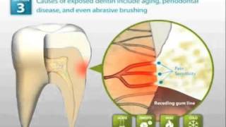 Remineralizing Tooth Enamel [upl. by Downall]