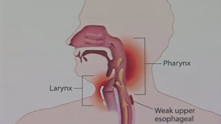 Good Question What Causes Laryngitis [upl. by Amsirp]