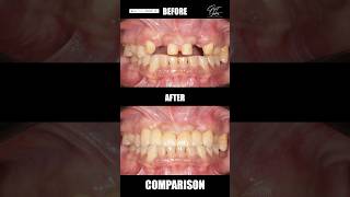 Dental Bridge Procedure  Treatment of Missing Front Teeth  Fixed Artificial Teeth  dentalbridge [upl. by Krispin]