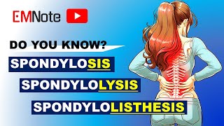 Spondylosis Spondylolysis and Spondylolisthesis [upl. by Lynd]