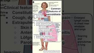 Common features of sarcoidosis [upl. by Ellak]