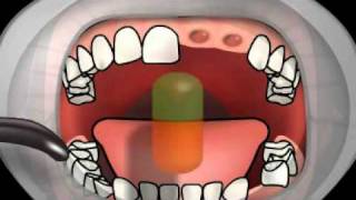 Dental Alveolitis [upl. by Grae]