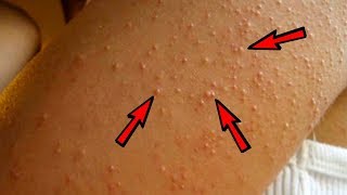 Natural Treatment to Get Rid of Keratosis Pilaris Chicken Skin [upl. by Lynch]