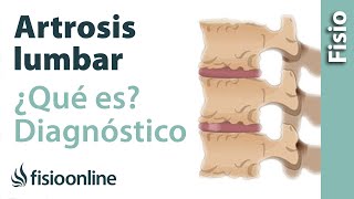 Artrosis lumbar  Qué es y cómo se diagnostica en radiografías [upl. by Osnerol388]