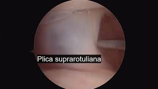 Suprapatellar Plica and loose body [upl. by Fontes]